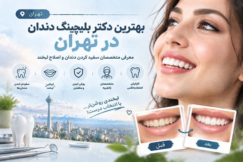 بهترین دکتر بلیچینگ دندان در تهران